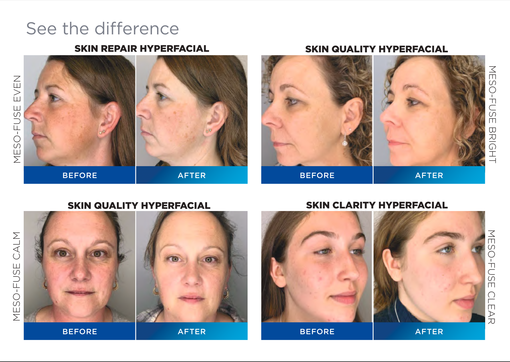 Before and after results: Skin Repair, Skin Quality and Skin Clarity HyperFacials protocols using MESO-FUSE serums